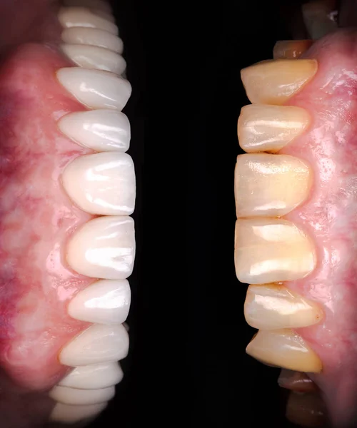 Sourire Parfait Avant Après Placages Javellisant Prothèse Céramique Arc Zircon — Photo