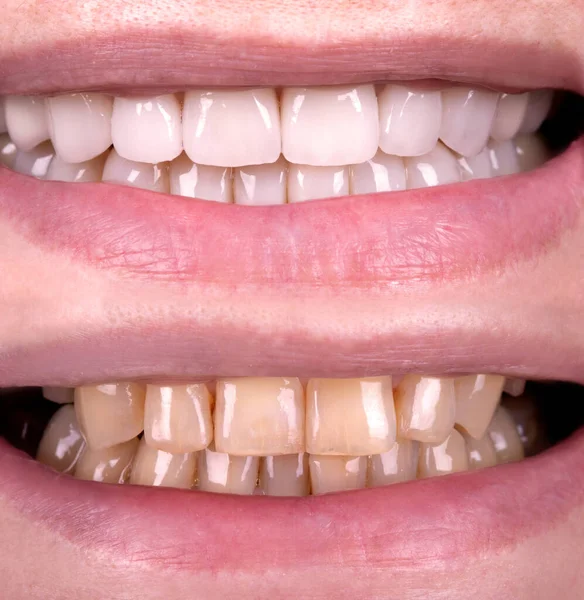 Perfektes Lächeln Vor Und Nach Veneers Bleiche Von Zirkon Bogen — Stockfoto