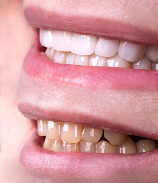 Perfektes Lächeln Vor Und Nach Veneers Bleiche Von Zirkon Bogen — Stockfoto