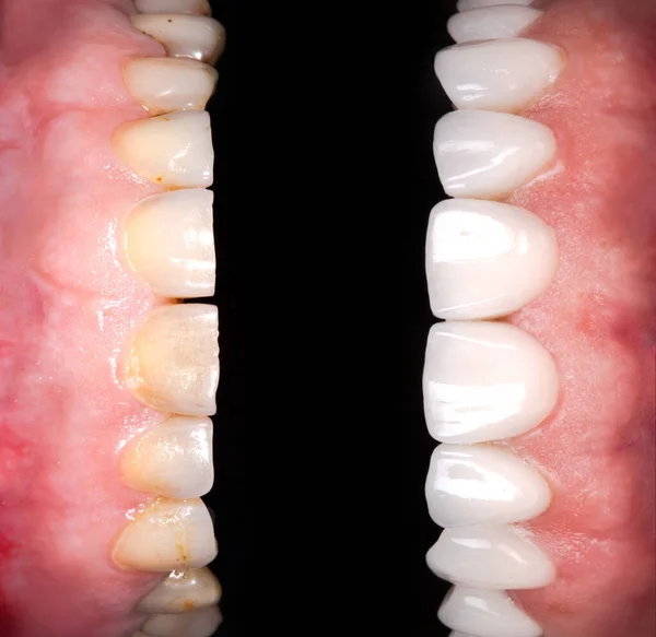 Perfect smile before and after veneers bleach of zircon arch ceramic prothesis Implants crowns. Dental restoration treatment clinic patient . Adult old woman surgery procedure whitening dentistry