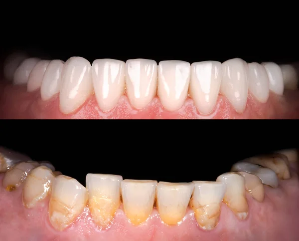 Sourire Parfait Avant Après Placages Javellisant Prothèse Céramique Arc Zircon — Photo