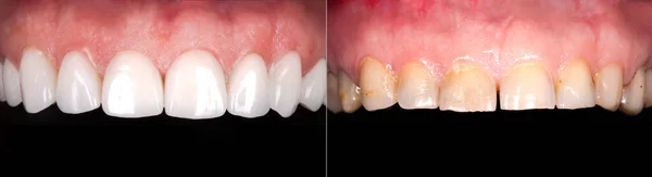 Sorriso Perfeito Antes Depois Folheados Alvejante Zircão Arco Prótese Cerâmica — Fotografia de Stock