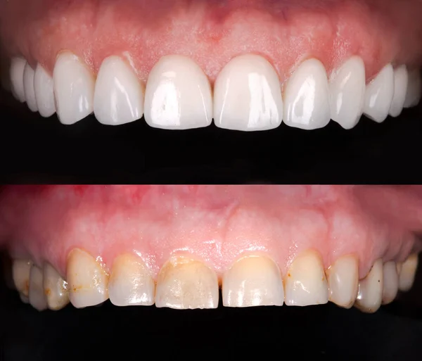 Perfect smile before and after veneers bleach of zircon arch ceramic prothesis Implants crowns. Dental restoration treatment clinic patient . Adult old woman surgery procedure whitening dentistry