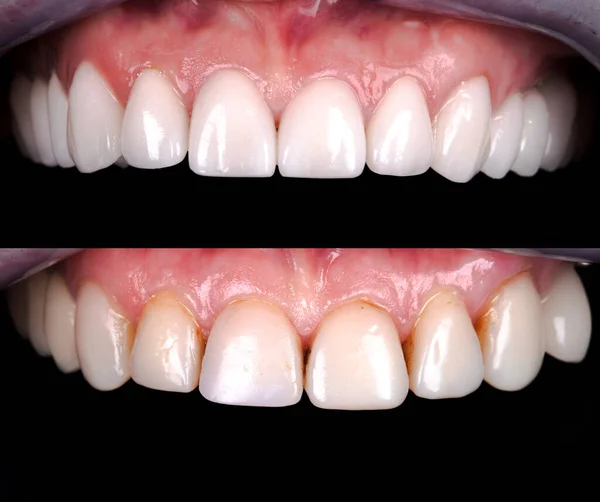 Perfect smile before and after veneers bleach of zircon arch ceramic prothesis Implants crowns. Dental restoration treatment clinic patient . Adult old woman surgery procedure whitening dentistry