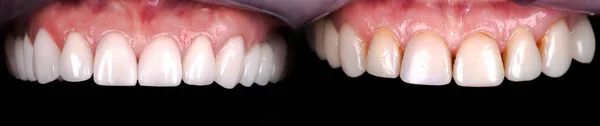 氧化锆拱形陶瓷假体植入冠冕前 后的完美笑容 牙科康复治疗诊所的病人 老年妇女牙齿美白手术程序 — 图库照片