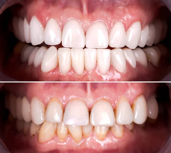 初心者の前と後の完璧な笑顔ジルコンアーチセラミックプロテーゼの漂白インプラントクラウン 歯科修復治療クリニック患者 成人女性の手術手順美白歯科 — ストック写真