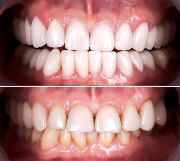 Sorriso Perfeito Antes Depois Folheados Alvejante Zircão Arco Prótese Cerâmica — Fotografia de Stock