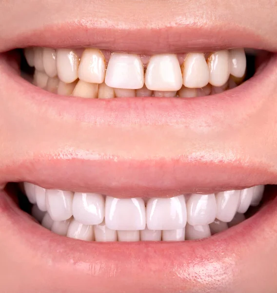 Perfektes Lächeln Vor Und Nach Veneers Bleiche Von Zirkon Bogen — Stockfoto