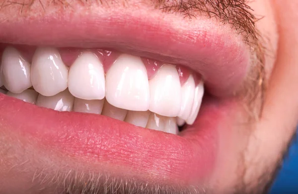 Perfekte Nahaufnahme Weiße Schöne Veneers Zahnbleichkronen Bleaching Junge Dame Lächelt — Stockfoto