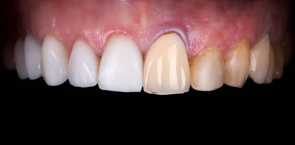 Perfect smile before and after veneers bleach of zircon arch ceramic prothesis Implants crowns. Dental restoration treatment clinic patient . Oral Care concept surgery procedure whitening dentistry