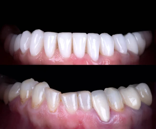 初心者の前と後の完璧な笑顔ジルコンアーチセラミックプロテーゼの漂白インプラントクラウン 歯科修復治療クリニック患者 口腔ケア概念外科手術 ホワイトニング歯科 — ストック写真