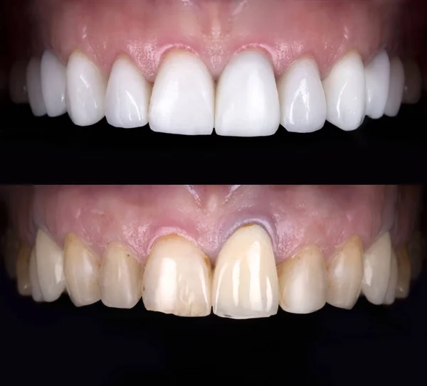 Perfect smile before and after veneers bleach of zircon arch ceramic prothesis Implants crowns. Dental restoration treatment clinic patient . Oral Care concept surgery procedure whitening dentistry