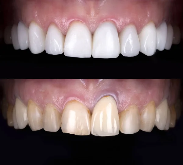 Sorriso Perfeito Antes Depois Folheados Alvejante Zircão Arco Prótese Cerâmica — Fotografia de Stock