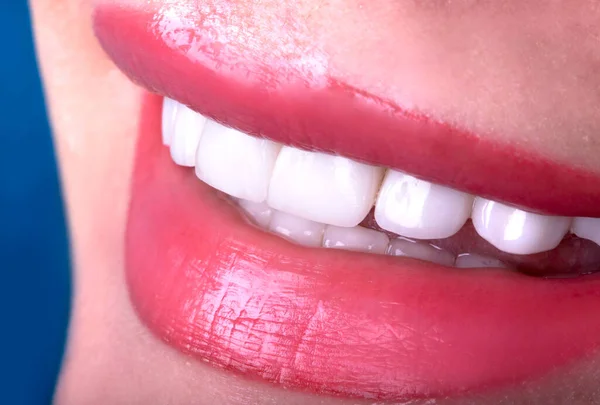 Perfetto Close Bianco Belle Impiallacciature Denti Corone Sbiancanti Giovane Signora — Foto Stock