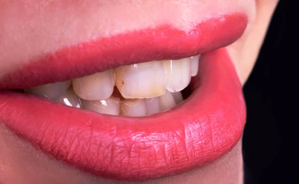閉じるダーティ曲がった黄色の歯の若い女性の笑顔 官能的な女性のふっくら唇の女性の笑顔を閉じます 歯科修復手術の概念 健康歯科医のコンセプト — ストック写真