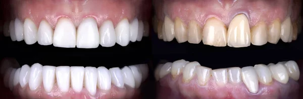 Senyum Sempurna Pemutih Sebelum Dan Setelah Veneers Pemutih Zirkon Lengkungan — Stok Foto