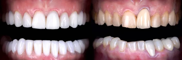 Senyum Sempurna Pemutih Sebelum Dan Setelah Veneers Pemutih Zirkon Lengkungan — Stok Foto