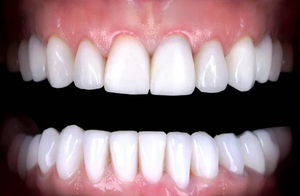 Perfect smile whitening veneers bleach of zircon arch ceramic prothesis . Implants crowns after Inter Dental restoration treatment clinic patient . Oral Care concept surgery procedure dentistry