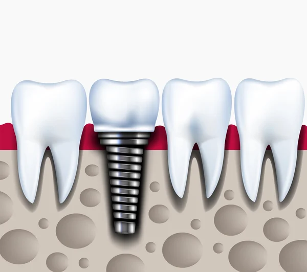 Анатомия здоровых зубов и зубной имплантат в челюстной кости . — стоковый вектор