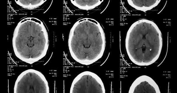 Radiographie Médicale Rayons Cerveau Humain — Video