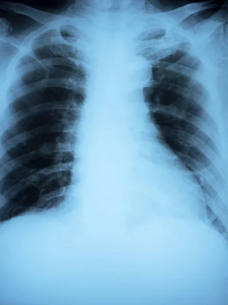 X光背景 近视人类胸部X光片 垂直风格 — 图库照片