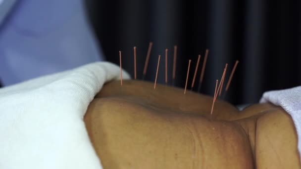 针灸治疗过程中用钢针对老年妇女后背的近距离观察 — 图库视频影像