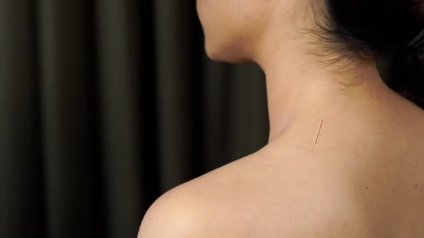 在肩上接受针灸治疗的年轻妇女 — 图库视频影像
