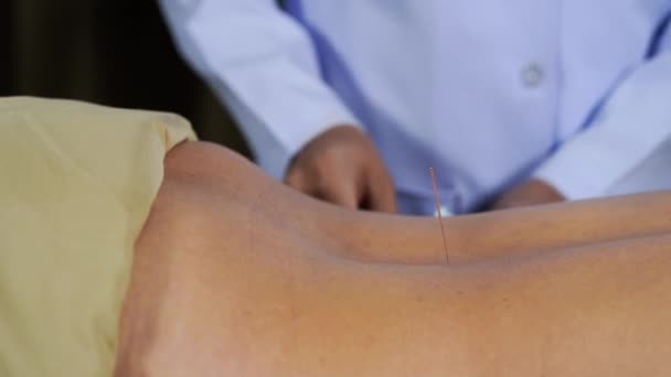 Close Woman Undergoing Acupuncture Treatment Back — Stock Video