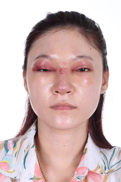 Mujer con nariz y ojos hinchados después de una operación de nariz —  Fotos de Stock