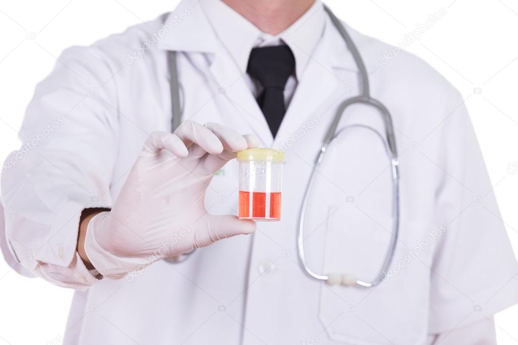 doctor's hand holding a bottle of bloody urine sample