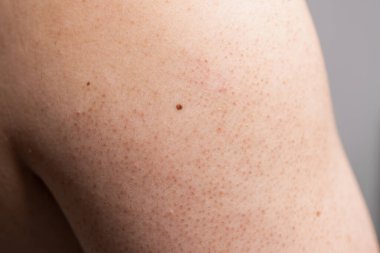 Dermatolojik sağlığın önemini vurgulayan bir cilt hastalığına yakından bakmak.