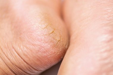 Çatlak cilt sağlığını ve rahatlığını iyileştirmek için etkili ev hapları araştırın.