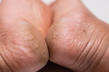 Kuru eller için etkili cilt bakımı ipuçları ve pürüzsüz sağlıklı cilt elde etmek için dirsekler araştırın.