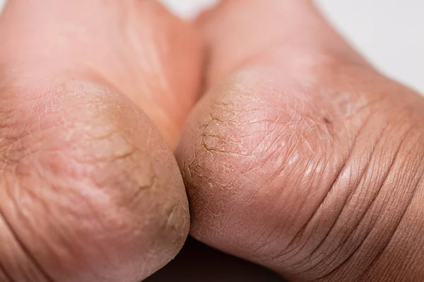 Kuru eller için etkili cilt bakımı ipuçları ve pürüzsüz sağlıklı cilt elde etmek için dirsekler araştırın.