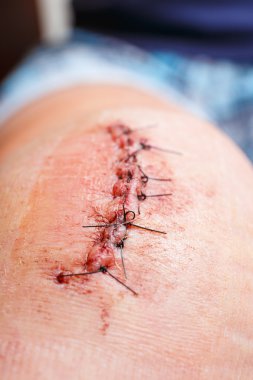 Siyah bir fiber operasyondaki iz