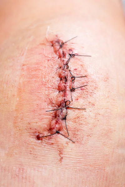 Cicatriz de operação com uma fibra preta — Fotografia de Stock
