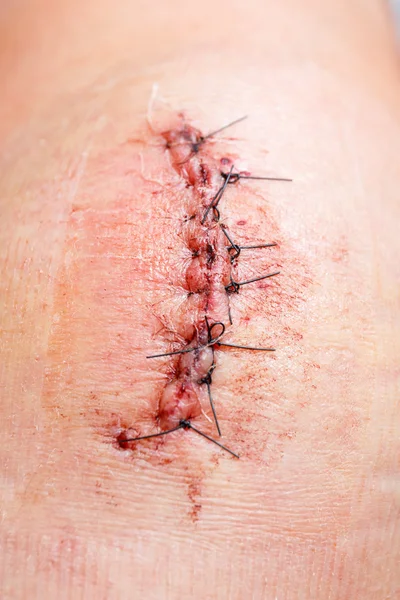 Scar from operation with a black fiber — Stock Photo, Image