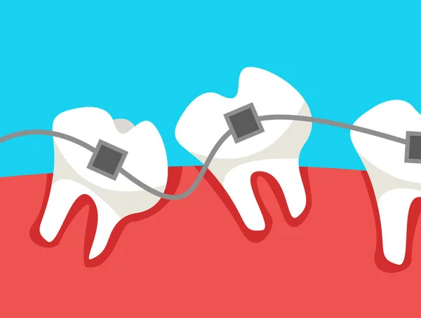 Una Cavidad Oral Con Dientes Torcidos Los Que Usan Aparatos — Archivo Imágenes Vectoriales