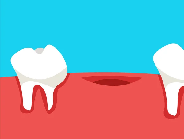 Στοματική Κοιλότητα Λείπει Δόντι Στο Στόμα Επίπεδη Διανυσματική Απεικόνιση — Διανυσματικό Αρχείο