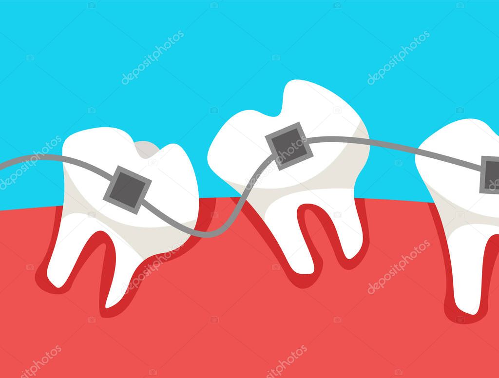 An oral cavity with crooked teeth on which braces are worn. Flat vector illustration.