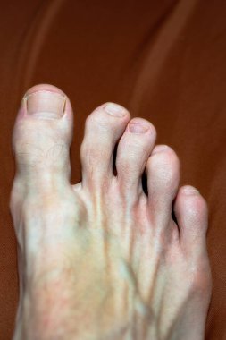 El ve ayak parmaklarındaki osteofitler Heberden 'in düğümü ya da Bouchard' ın düğümleri olarak bilinir.