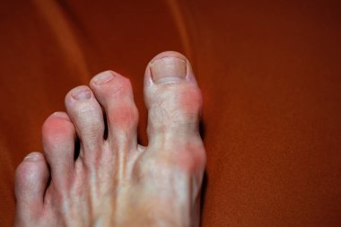 Ayak parmaklarında iltihap ve deformasyon. Ayak parmaklarında kemik ve yumuşak doku tümörleri olan maffuçi sendromu, seçici odaklanma