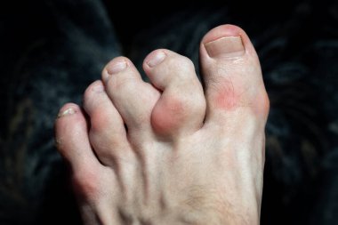 Osteofitlerle şişmiş ve deforme olmuş parmaklar. Gut ve eklem iltihabından dolayı ayak parmaklarında iltihap var. Ayak parmaklarının şişmiş eklemleri