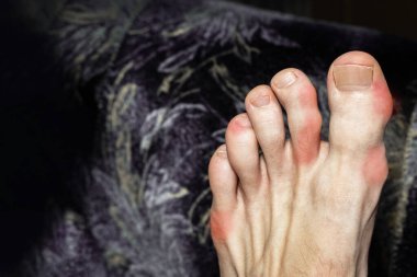 Romatoid artrit ya da gut genç beyaz adamın ayak parmaklarını etkiler. Akut iltihaplı eklem iltihabının yinelenen atağı (kırmızı, hassas, sıcak, şişmiş eklemler). Acı verici gut iltihabı, seçici odaklanma