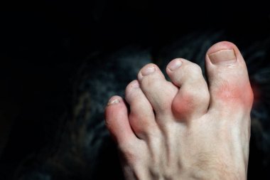 Ayak parmaklarındaki osteofitler gut ya da Ollier hastalığından yaralanmış. Ayak parmaklarında iltihap ve deformasyon. Ayak parmaklarında kemik ve yumuşak doku tümörleri olan maffuçi sendromu. Parmak kemiklerinde kemik hücreleri var.