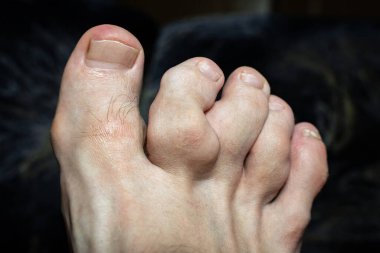 Birden fazla kırıktan sonra deforme olmuş ayak parmakları. Ayak parmaklarının eklemlerinde şişlik var. Ayak eklemlerinde ağrılı gut iltihabı, seçici odaklanma. Gut parmaklar. Gut hastalığından etkilenen ayak parmakları, seçici odaklanma