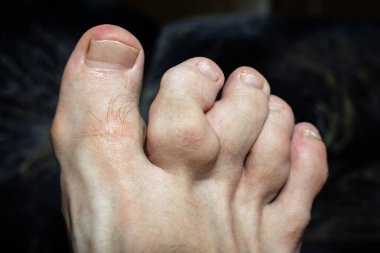 deformed toes after multiple fractures. swelling of the joints of the toes. Painful gout inflammation on toe joints, selective focus. gouty toes. toes affected by Gout, selective focus clipart