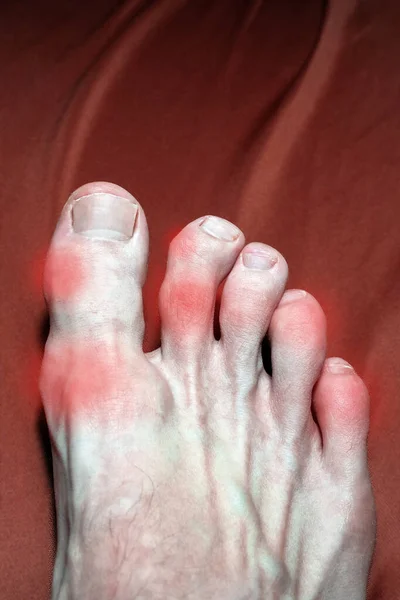 Inflamed Deformed Joints Toes Due Arthritis Gout Swollen Deformed Fingers — Stock Photo, Image