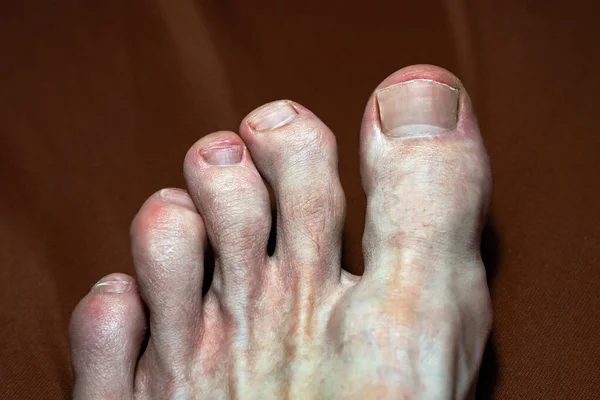 Close Gouty Toes Toes Affected Gout Disease Which Defective Metabolism — Stock Photo, Image