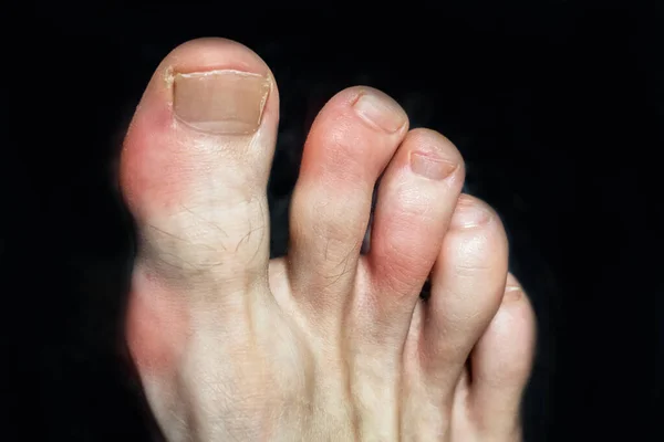 Osteofyten Tenen Van Een Voet Gewond Door Jicht Ziekte Van — Stockfoto